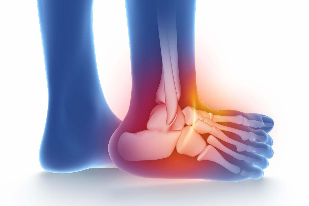 Overwin Sinus Tarsi Syndroom Fysiotherapie Leeuwarden First Fysio