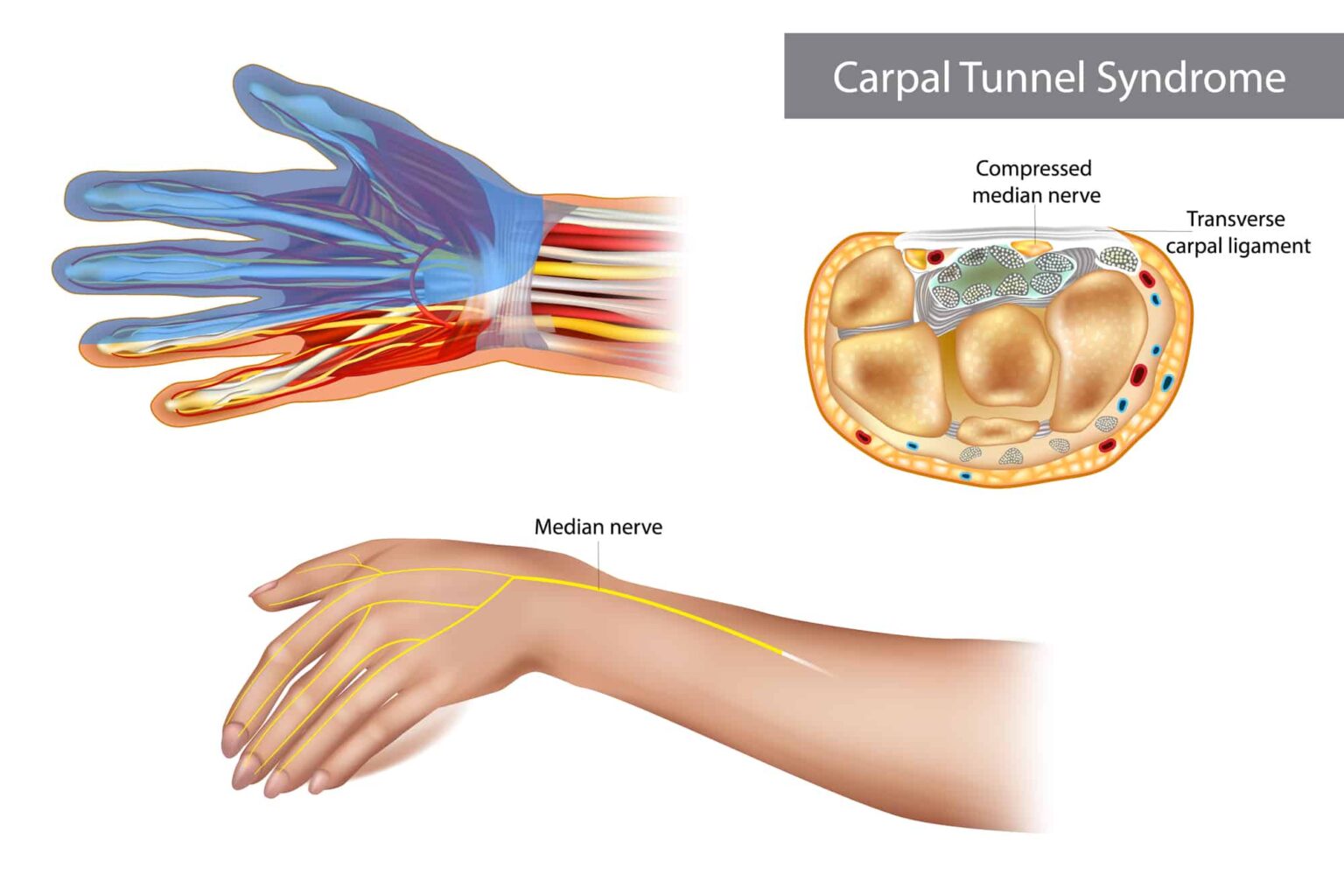 Carpaal Tunnel Syndroom Klachten Fysiotherapie Leeuwarden First Fysio